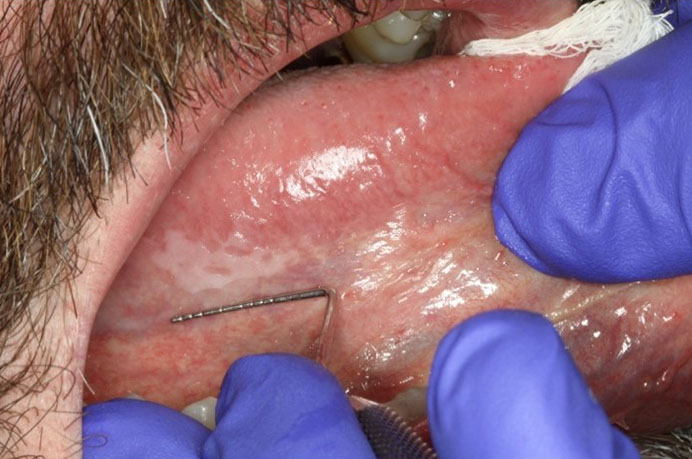Oral Leukoplakia 1