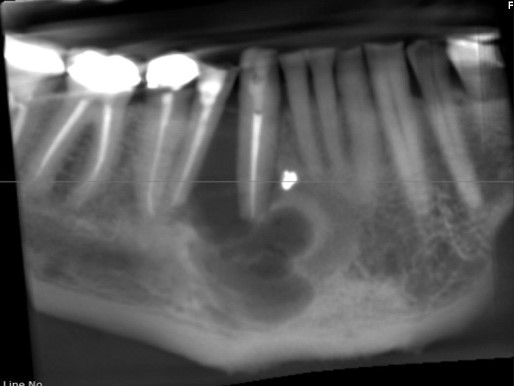 Multicameral radiolucency of the anterior mandible